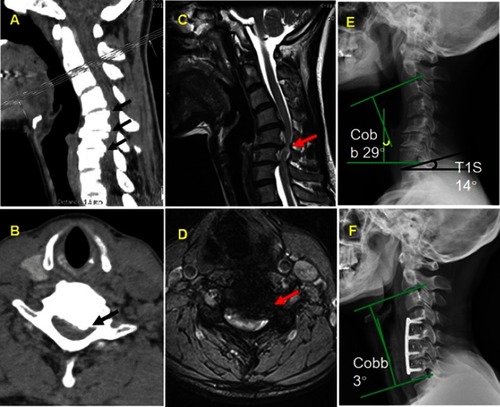 Figure 1 The multilevel compression of spinal cord with heterotopic ossification on CT (A, B) and ISI of spinal cord on MRI (C, D). The kyphotic alignment with C2–7 Cobb =29 angle (E) and three-levels ACDF were performed at final follow-up (F).