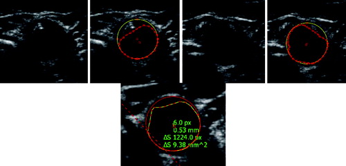 Figure 10. Sample result of the proposed algorithm for artery detection and segmentation.