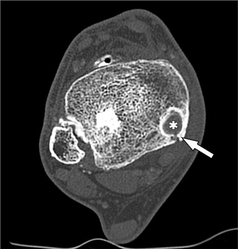 Figure 2. Ax CT scan, showing the tibialis posterior tendon (*) in a medial retromalleolar bone tunnel and the healed posterior malleolus fracture (red line).