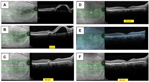 Figure 5 OCT images of anti-VEGF monotherapy for PCV.