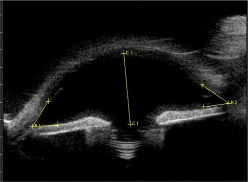 Figure 1 Ultrasound biomicroscopy showing intraocular lens position and open angle for the eye of patient number 3, with aphakia and retropupilar iris claw intraocular lens.