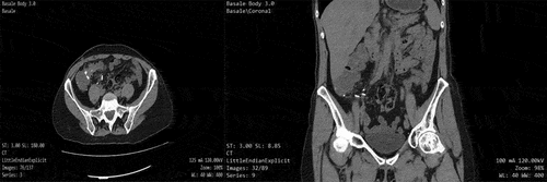 Figure 6. CT scan at three months follow-up. No hypodense formation revealed and did not show mesenteric and retroperitoneal adenopathy.