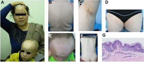 Figure 1 Skin lesions and histopathology.