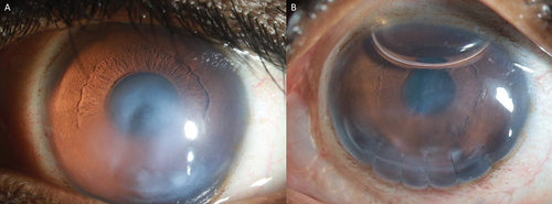 Figure 7. (a, b): a: Preoperative slit-lamp photograph of the left eye of patient 6; b: Postoperative image after 1 h of the surgery.