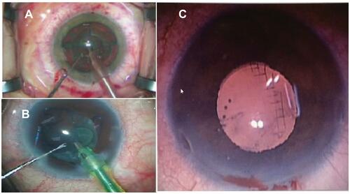 Figure 3 FLACS complications: (A) post docking conjunctival ecchymosis. (B) Intraoperative miosis managed with Malyugin ring. (C) Corneal laser grid pattern.