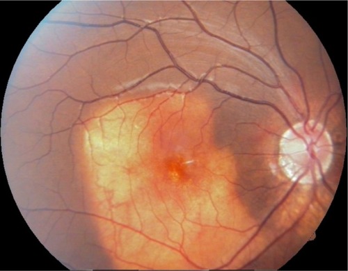 Figure 1 Fundus picture showing a typical orange-yellowish lesion.