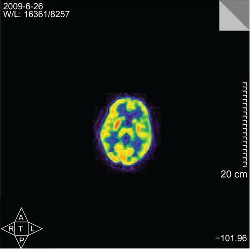 Figure 1 Increased glucose metabolism of the bilateral putamen with positron emission tomography scan, more obvious on the right side.