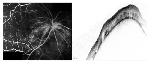 Figure 2 Fluorescein angiogram and corresponding spectral-domain optical coherence tomography image of peripapillary renal cell carcinoma metastasis of the right eye.