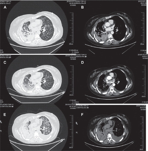 Figure 1. Radiologic images before and after sunitinib 37.5 mg/d. A and B. Chest CT-scan of the thorax one week prior to sunitinib treatment (7 September 2010). C and D. Chest CT-scan of the thorax three days after one cycle of sunitinib treatment (15 October 2010). E and F. Chest CT-scan of the thorax one week after two cycles of sunitinib treatment (29 November 2010).