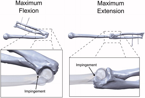 Figure 5. Examination of the simulation-predicted impingement locations. Flexion was limited by impingement of the coronoid process in the coronoid fossa. Extension was limited by impingement of the olecranon in the olecranon fossa.