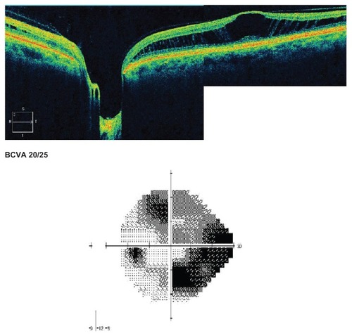 Figure 3 Observed patient with schisis cavity, and visual field deficit.(Patient 2, Table 2)