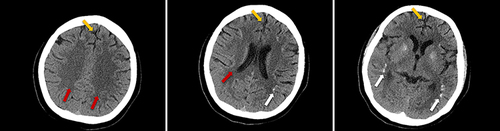 Figure 1 The images of Brain CT (axial view). Yellow arrow: this arrow reveals the slightly widened and deepened sulcus, and slightly narrowed frontal parietal gyrus. Red arrow: this arrow reveals the bilateral semioval centre and lateral ventricle brain white matter region low-density changes. White arrow: this arrow reveals the scattered calcifications.