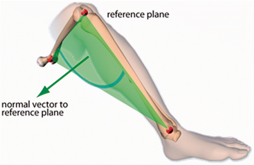 Figure 2. Ankle epicondyle piriformis (AEP) plane formed by the mid-point of the ankle malleoli, the mid-point of the femoral epicondyles, and the piriformis fossa. The normal vector to this plane is used instead of the condylar axis in imageless navigation to define the neutral rotation of the femur