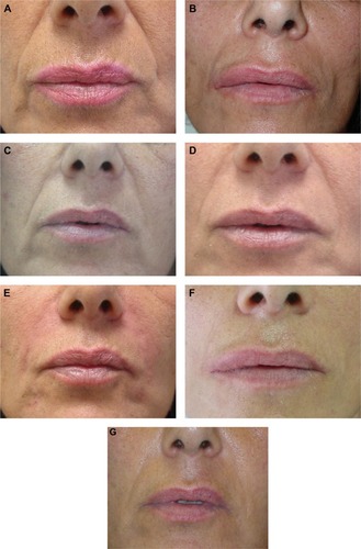 Figure 3 A 48-year-old female (Wrinkle Severity Rating Scale grade 3) before and after application of 0.6 mL/side of cross-linked carboxymethyl cellulose and reapplication of 0.5 mL/side at Month 9.Notes: (A) Before treatment; (B) Month 3; (C) Month 6; (D) Month 9 before reapplication; (E) Month 9 after reapplication; (F) Month 12; (G) Month 18.