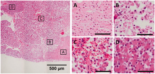 Figure 4. Representative images of the different degrees of thermal damage induced by HIFU in the porcine pancreas, from sample 4/2. The scale bars in the subfigures represent 50 µm. (A) Center of the focal area, exhibiting coherent cells with fragmented nuclei and no hemorrhage. (B, C) Border region, exhibiting a loss of cohesion between cells and hemorrhage. (D) Healthy pancreas parenchyma.