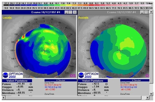 Figure 1 Preoperative topographic corneal map of a 26-year old female patient (DPL) in group 1. Absolute scale, left tangential map, right axial map (Keratron Scout, Optikon 2000).