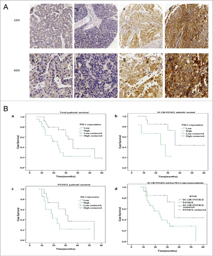 Figure 2. PD-L1 expression in tumor tissues and its correlations with the prognosis of HCC patients undergoing POTACE and POTACE plus DC-CIK cell therapy, respectively. (A) Representative images of the immunohistochemical staining of PD-L1 expression in tumor tissues that were related to the physiological scores of IRS at 0,2,6 and 9. (a,e) represented IRS at 0. (b,f) represented IRS at 2. (c,g) represented IRS at 6. (d,h) represented IRS at9. (a-d,100x magnification; e-h, 400x magnification). (Ba) In total cohort, the Kaplan-Meier curves of patients with the high and low PD-L1 expression level in tumor tissues, respectively. As shown in this panel, the HCC patients with the low expression of PD-L1(blue line, IRS≦3, n = 25) have significant long OS as compared with that of patients with high expression of PD-L1(blue line, IRS>3, n = 21) (log rank, p = 0.015). (Bb) In DC-CIK cell therapy plus POTACE treatment group, the Kaplan-Meier curves of patients with the high and low PD-L1 expression level, respectively. The low expression of PD-L1(blue line, IRS≦3, n = 13) have significant long OS as compared with that of patients with high expression of PD-L1(blue line, IRS>3, n = 6) (log rank, p = 0.033) (Bc) In POTACE alone group, the Kaplan-Meier curves of patients with the high and low PD-L1 expression level, respectively. There was no significant difference in the overall survival between two groups (log rank, p = 0.192). (Bd) the Kaplan-Meier curves of the patients with low expression of PD-L1 undergoing POTACE+DC-CIK cell therapy and the patients undergoing POTACE alone. The overall survival duration in patients with underexpressed PD-L1 in study group(n = 6) was much longer than those in control group (n = 27, log rank, p = 0.033). The blue line represents low expression group and the green line represents high expression group. P < 0.05 signified statistical significance; blue and green line represents the low and high expression of PD-L1, respectively. Plus sign (+) on the line represents censored data.