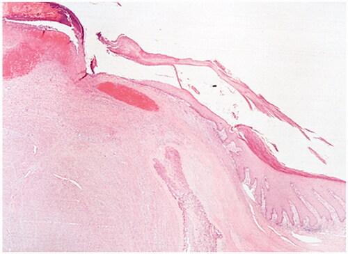Figure 4. Fibro-osseous pseudotumor of digits. The lesion presents as a well-circumscribed dermal mass, with epidermal ulceration. Hematoxylin-eosin × 25.