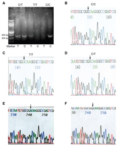 Figure 1 Sequencing results from healthy controls. (A) The 389-base pair PCR amplification fragments with allele-specific primer set TM-Ala and TM-Val from controls analyzed by allele-specific amplification. Lanes show the band patterns in controls with the allele combinations C/T, T/T, and C/C at position 1418. M represents the DNA marker. (B–D) PCR amplification fragment direct and reverse sequencing map with three genotype (C/T, T/T, and C/C analyzed by allele-specific amplification) DNA as template, respectively. Because of reverse sequencing, A and G (indicated by arrow) should be T and C at position 1418. (E and F) Two kinds of TM-pGEM® plasmid clone reverse sequencing map confirm the T/C heterozygous genotype analyzed by allele-specific amplification. A and G indicated by arrow should also be T and C as above.