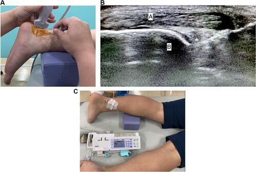 Figure 2 Experimental ankle pain model. (A) Set-up of the flexible catheter insertion. (B) Ultrasound image of the catheter inserted into Kager’s fat pad (A) Calcaneus, (B) Achilles tendon, Kager’s fat pad (yellow), catheter (white). *Tip of the catheter. (C) Syringe infusion pump attached to the catheter.