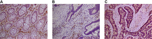 Figure 6 (A) The expression of VSIG2 in normal tissues. (B) The expression of VSIG2 in cancer tissues. (C) The expression of LC3 in cancer tissues.