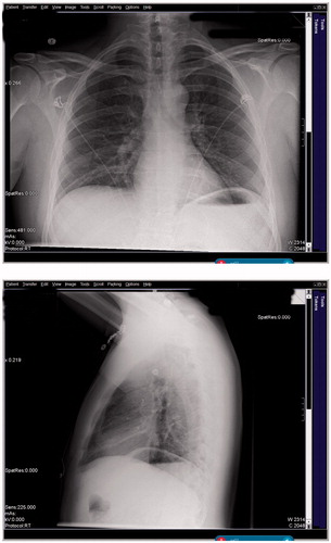 Figure 2. The patient’s chest X-ray demonstrating small right lower lobe infiltrate.