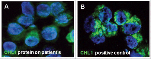 Figure 3. (A) Immunofluorescence staining revealed that CHL1 protein (green) expression on tumor cells from the patient was weaker than positive control. (B) HL-60 cell line (positive control) show strong staining. Nuclei are stained with DAPI (blue). Original magnification 100x.