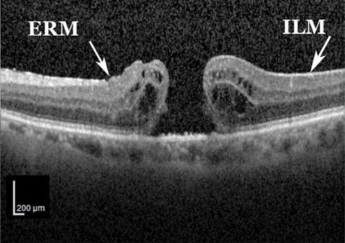 Figure 3 Post-traumatic optical coherence tomography showing a full-thickness macular hole.