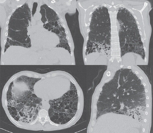 Figure 2. Chest CT scans at the time of aspergillosis relapse and diagnosis of M. avium infection. New infiltrates located dorsally in the right lower lobe and in the left lower lobe.