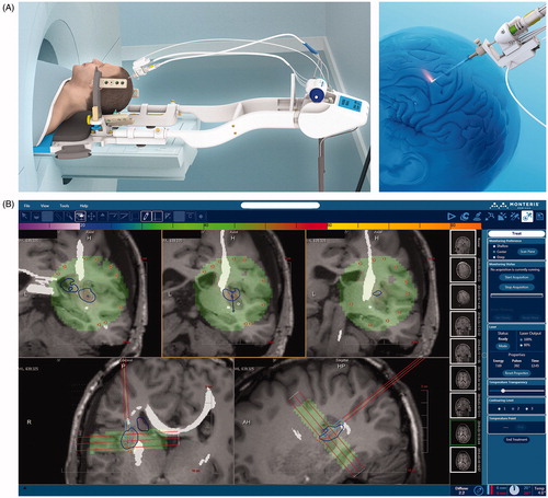 Figure 2. Cranial laser interstitial thermal therapy. (A) Schematic depiction of the NeuroBlate® LITT delivery system (Monteris Medical, Winnipeg, Manitoba, Canada). The laser probe is stereotactically inserted through an approximately 0.5 cm skin incision and bur hole in the skull. The patient is then placed in the MRI scanner and the laser is activated remotely, with pulses interleaved with MRI acquisition for temperature monitoring. (B) Computer interface of the NeuroBlate® LITT delivery system (Monteris Medical, Winnipeg, Manitoba, Canada). MRI scans acquired while the probe is firing are overlaid in the computer interface with thermal damage threshold lines (blue TDT line shown here represents 43 °C for 10 min). As shown here, intraoperative MRI sequences can also be merged with previously acquired diffusion tensor MR imaging to highlight critical white matter tracts such as the corticospinal tract.