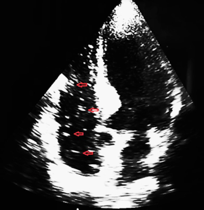 Figure 1. Air bubble in the right ventricle on cardiac ultrasound.