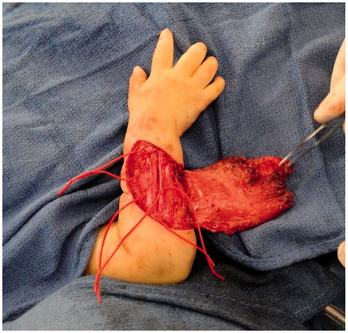 Figure 5. Intra-operative photograph after extensor tenolysis and prior to final flap inset.