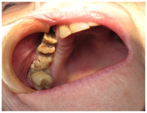 Figure 1 Patient with ONJ lesion in the right maxilla.