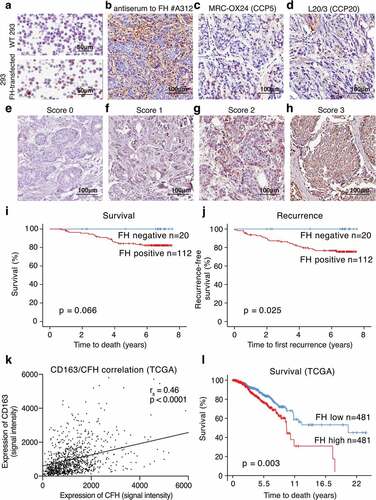 Figure 7. FH produced in breast tumors correlates with recurrence, disease severity and occurrence of M2 macrophages