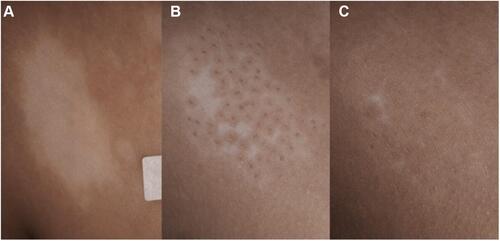 Figure 4 Trunkal vitiligo lesion treated with mini-punch grafts followed by transverse needling sessions. (A) Baseline surface area of 7.9 cm2. (B) 88.6% Repigmentation after 3 months. (C) 91.1% Repigmentation after 6 months with excellent color match.