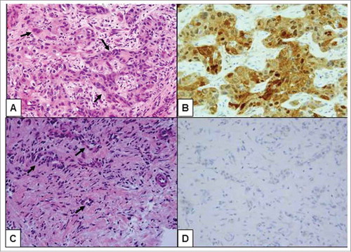 Figure 1. Histologic review of the second biopsy showed high grade pancreatic ductal adenocarcinoma (PDA), metastatic to the liver throughout the tissue cores (original magnification 400X). (A) Areas of undifferentiated tumor cells containing markedly pleomorphic nuclei were arranged in highly cellular nests and clusters of malignant cells (arrows) within a relatively scarce fibrotic stroma. (B) These undifferentiated tumor cells were positive by immunohistochemistry for IDH1 (R132H) mutation. (C) Distinct areas of the tumor biopsy demonstrated less tumor pleomorphism that was more characteristic of conventionally tubular morphology (arrows). (D) In contrast to high grade foci, the well-differentiated foci were negative by immunohistochemical stain for IDH1 (R132H) mutation, consistent with IDH1 wild type status of tumor cells in these areas.