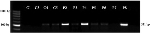 Figure 3. Quantitative expression of D3 mRNA in control (C) and drug-free patients (P2, P3, P4, and P5) and treated ones (P6, P7, and P8).