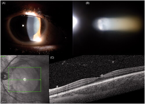 Figure 1. Autoimmune Uveite. (A) Endothelial depositsvand and iris nodules; (B) Flare and Tyndal; (C) SD-OCT Vitreitis.