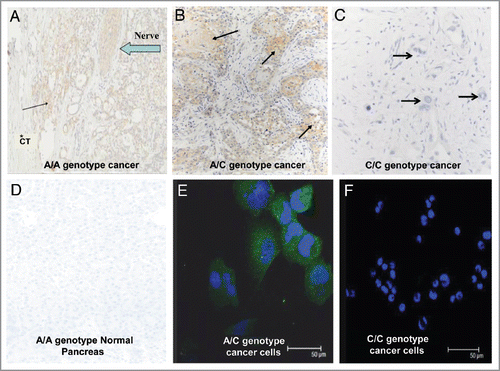 Figure 3 CCKCR phenotype is associated with the presence of the SNP A/A or A/C genotype. (A) CCKCR immunoreactivity is found in malignant cells of a pancreatic cancer of a patient having genotype A/A. CCKCR immunoreactivity is identified in a nerve invaded by cancer cells (arrow). The surrounding connective tissue (*CT) is void of CCKCR staining. (B) CCKCR positive immunoreactivity is seen from a pancreatic tumor of a patient with genotype A/C (arrows point to cancer cells). Again note the fibrous connective tissue surrounding the cancer cells is void of receptors. (C) A pancreatic cancer specimen from a subject with genotype C/C shows lack of CCKCR immunoreactivity. Arrow is pointing to malignant glands where cancer cells do not have the CCKCR. (D) A tissue specimen from a procured normal pancreas with genotype A/A showing the lack of CCKCR immunoreactivity in normal benign tissue. (E) PANC-1 cancer cells which have the A/C genotype show immunoreactivity to the CCKCR antibody by confocal microscopy. (F) AsPC-1 pancreatic cancer cells which have the C/C genotype do not react with the CCKCR antibody. Nuclei are stained with DAPI.