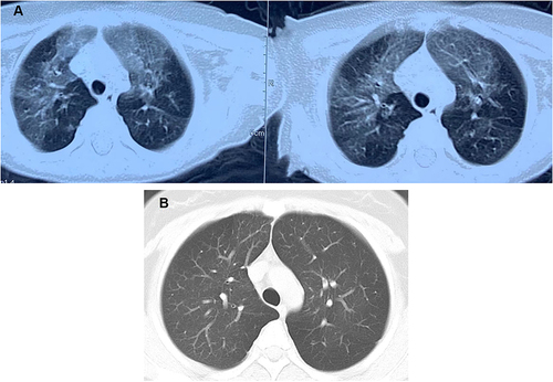 Figure 1 The HRCT of a girl with PIBO. (A) HRCT at diagnosis of PIBO. (B) Mosaic perfusion patterns disappeared after 6 years.