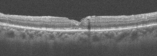 Figure 6 The inverted internal limiting membrane flap is seen over the fovea in the attached retina. The MH is closed and there is a presence and continuity of the outer retinal layers.
