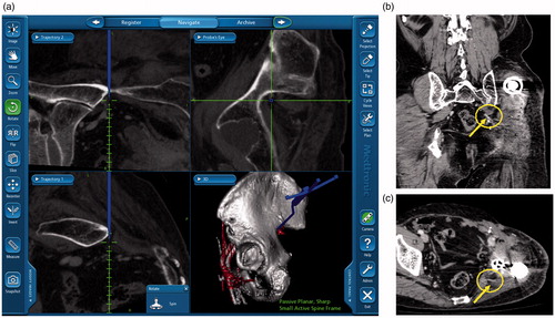 Figure 2. Intraoperative navigation view and postoperative CT 34 months after operation (Case 1). The inferior gluteal artery is indicated at the outlet of the greater sciatic notch with a dark blue line (a). The inferior gluteal artery (yellow arrows) on the operated side was preserved (b, c).