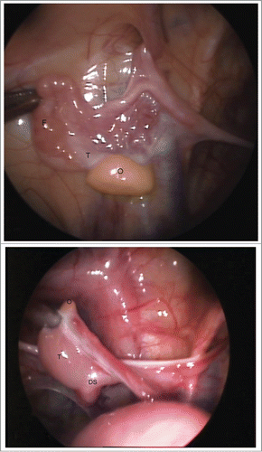 FIGURE 3. (a, b). A unique clinical case of ovotesticular DSD with rare form of 46,XX/46,XY chimerism was detected in a 1-year-old patient. Laparoscopically, the both gonads were ambiguous. Figure 3A. The left ovotestis: predominated ovarian (O) tissue (yellow), with whitish testicular structure on the upper pole, associated with the Fallopian tube (F) only. Figure 3B. The right ovotestis: predominated testicular tissue (T), with small ovarian structure (yellow) on the upper pole (O), associated with the ductus seminiferous (DS) alone. The ovarian (O) part seems like appendix testis.