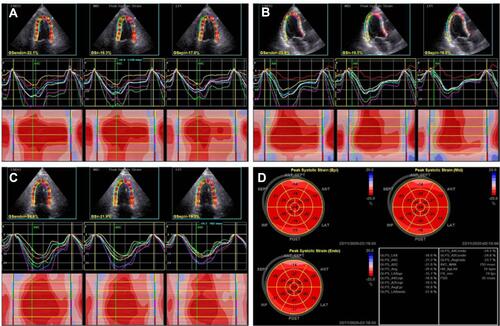 Figure 1 Strain analysis image of a subject, (A) Left ventricular longitudinal strain curve of apical four-chamber view, (B) Left ventricular longitudinal strain curve of apical long axis view, (C) Left ventricular longitudinal strain curve of apical two-chamber view, (D) Bull’s eye diagram of longitudinal strain of left ventricular endocardium, middle and epicardial layers.