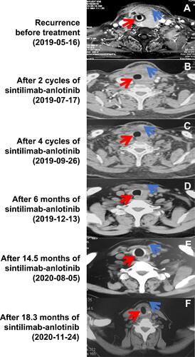Figure 1 Radiological monitoring of the patient before and after treatment with sintilimab plus anlotinib. (A) Magnetic resonance imaging (MRI) was performed on the recurrence before treatment (Baseline), on May 16, 2019. (B and C). Computerized tomography (CT) on July 17, 2019 (B) and September 26, 2019 (C) showed the tumor shrank after 2 and 4 cycles of sintilimab–anlotinib, respectively. (D) CT on December 13, 2019 identified a little residue of the recurrence mass. (E) CT after 14.5 months of the treatment showed a sustained and prominent reduction of the tumor. (F) The tumor shrinkage was continued over 18.3 months as shown by the CT on November 24, 2020. The red arrow indicates tracheal compression, whereas the blue arrow indicates the tumor.