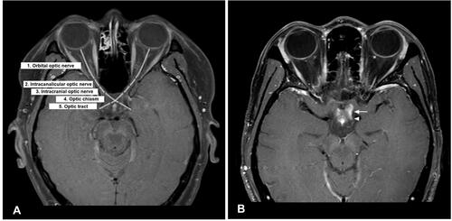 Figure 1 (A) Each AVP scan was composed of five segments: orbital optic nerve, intracanalicular optic nerve, intracranial optic nerve, optic chiasm and optic tract. (B) Fat-suppressed T1-weighted with gadolinium contrast axial MRI showing enhancement of optic chiasm (arrow) and optic tract (arrowhead).