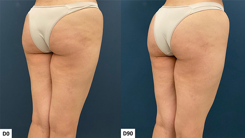 Figure 2 Case 1, Buttocks Beautification 3D. Standardized oblique images pre and 90 days post injection.