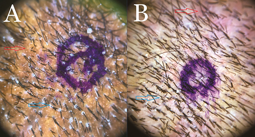 Figure 3 (A) Typical trichoscopy finding in the NAS of patients with AKN showing perifollicular scales (Blue arrow) and erythema (Red Arrow), manifesting as hyperpigmentation in a Black African patient. The blue ink mark indicates the biopsy site. (B) Typical trichoscopy finding in the NAS of patients with AKN showing perifollicular scales (Blue arrow) and erythema Red arrow) in a nonblack Hispanic patient. The blue ink mark indicates the biopsy site.