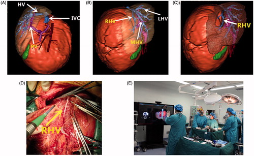 Figure 2. Comparison of 3D simulation and intra-operative liver anatomy.