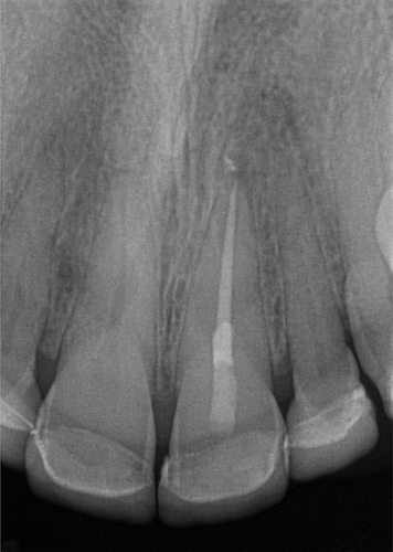 Figure 28. 6mo follow up showing access restored and complete apical healing.